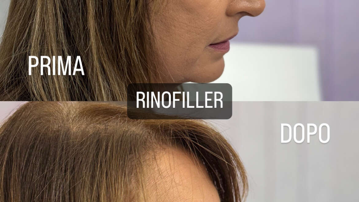 Rinofiller