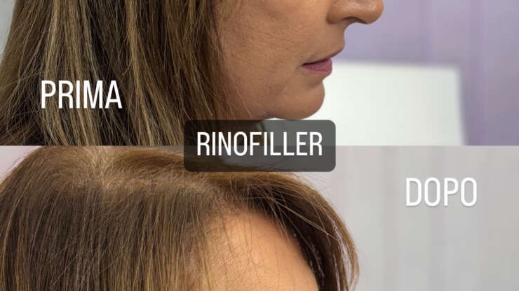 Rinofiller