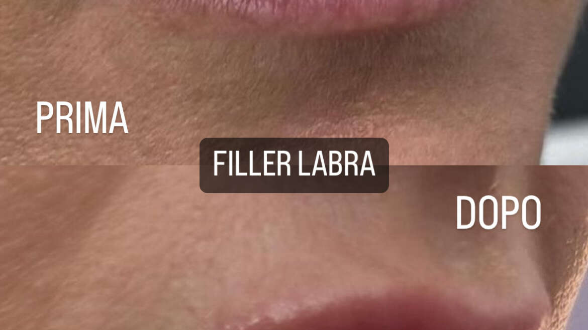 Filler labbra