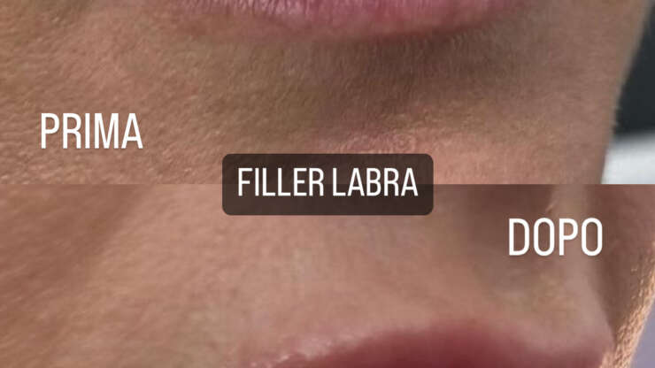 Filler labbra